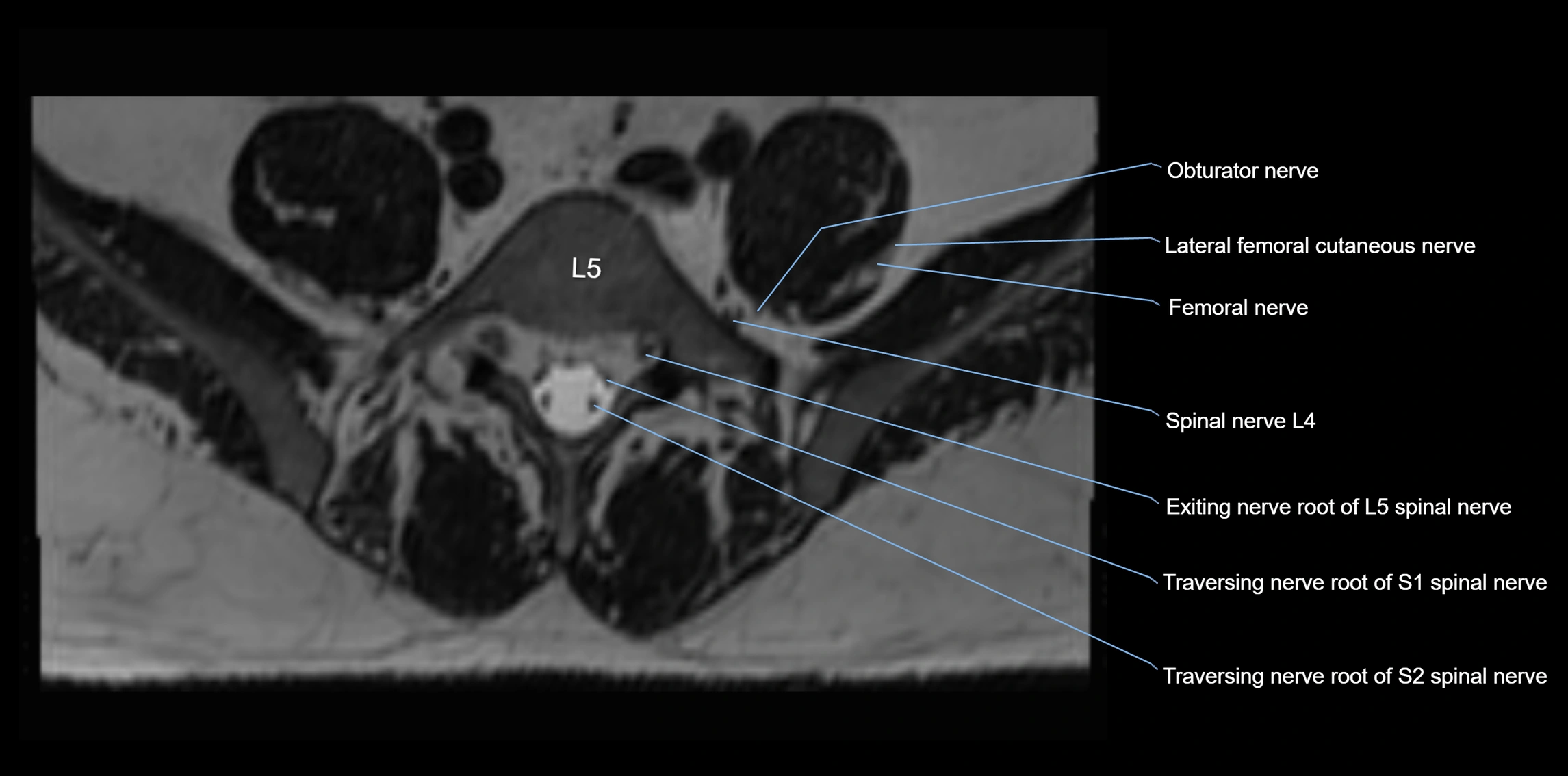 MR lumbosacral plexus axial cross sectional anatomy 3T  radiology  image-img-1008001-00056.webp